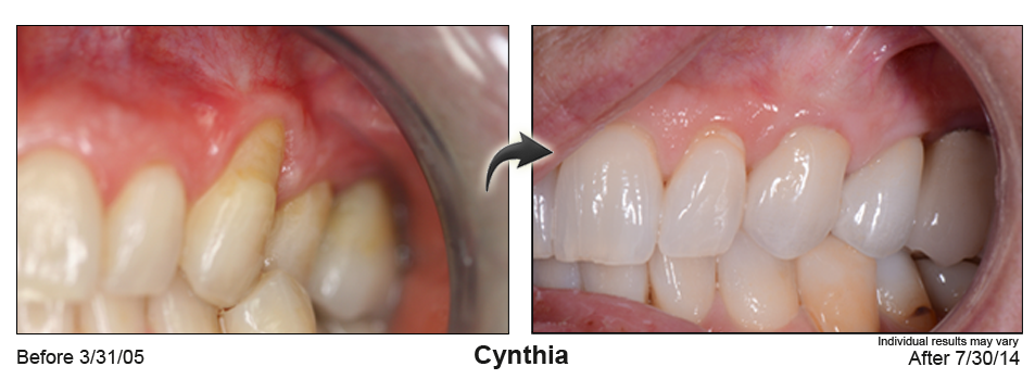 Corpus cristi gum rejuvenation