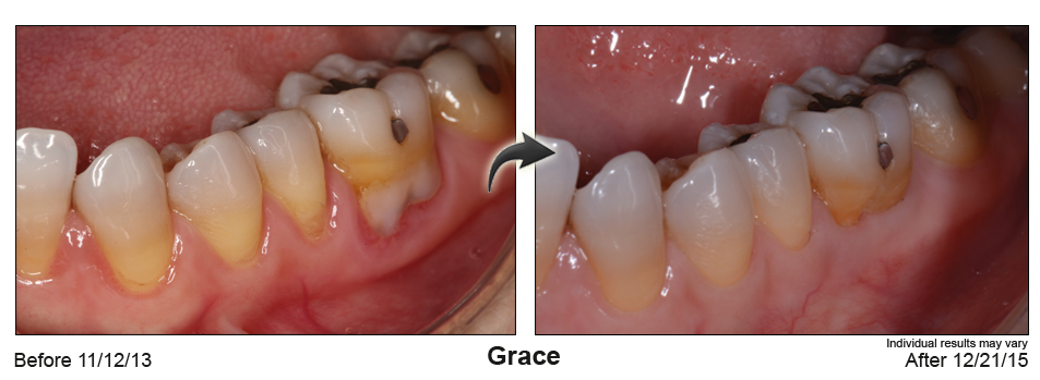 fix gum recession San Antonio