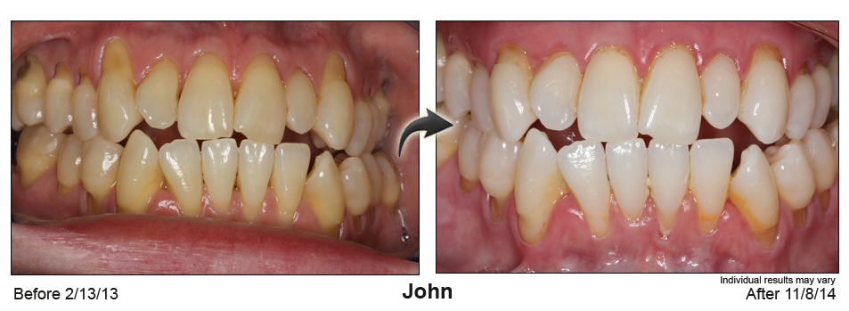 Boerne gum recession