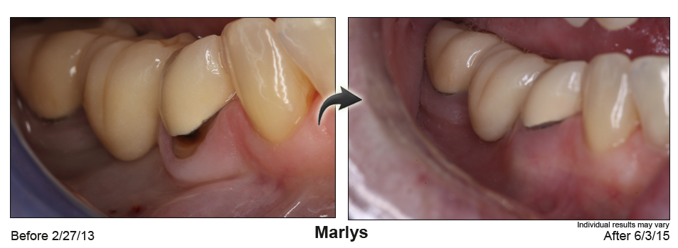 fix receding gums pleasanton